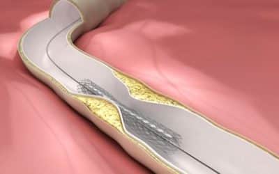 Angioplasty and Stent Placement Helps Open Up Block Arteries and Prevents Loss of Limbs