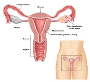 Uterine Fibroids