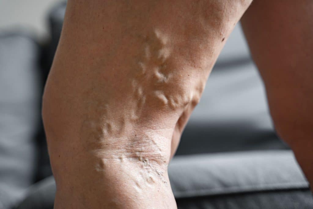 Leg Showing Varicose Veins