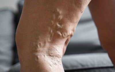 Varicose Veins: Symptoms You Should Know