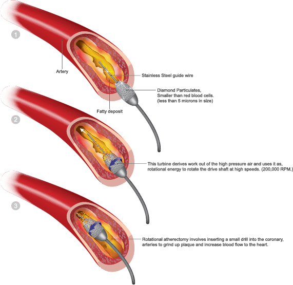 Atherectomy Atherectomy Procedure