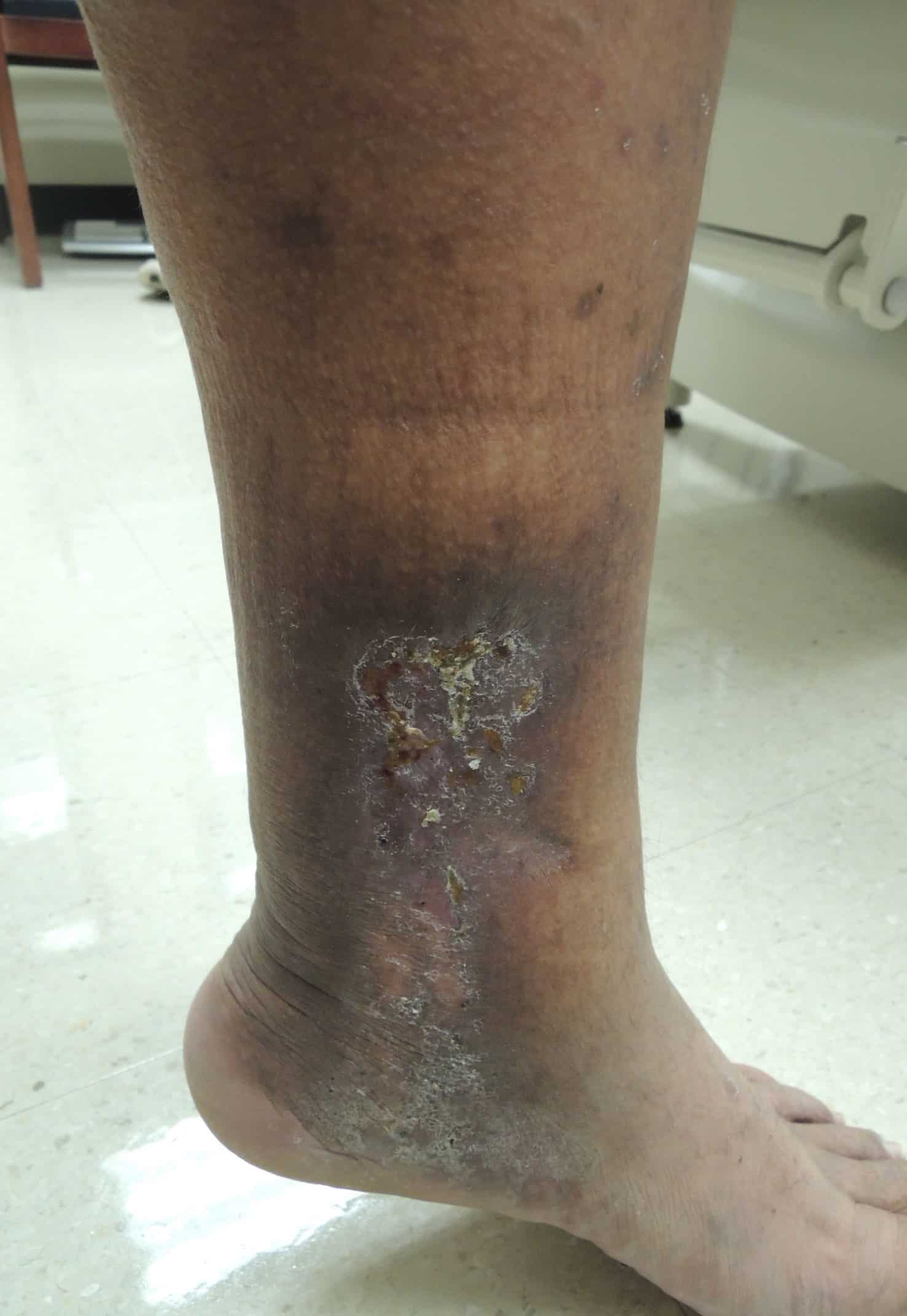 Skin changes associated with chronic venous insufficiency (CVI) Skin