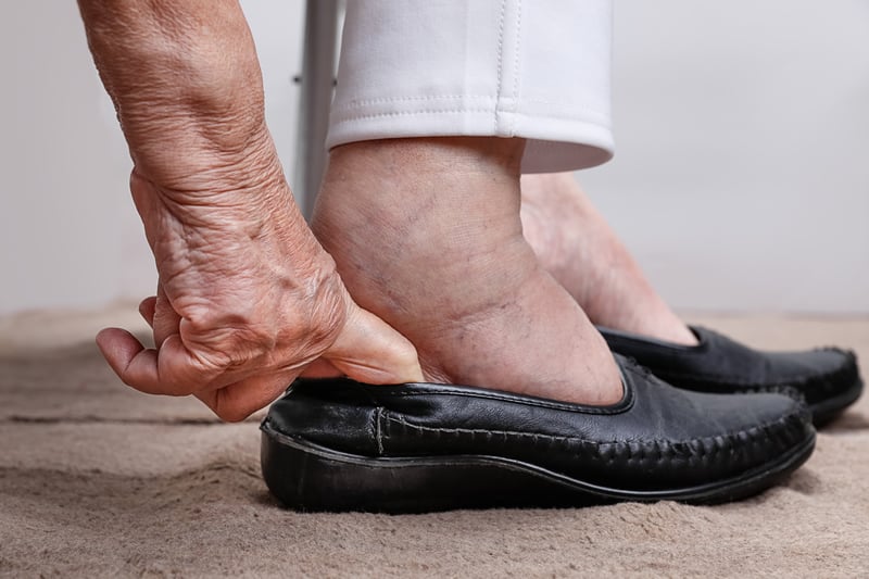 Foot, leg, and ankle swelling Information