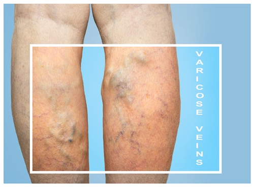 The Causes and Treatment of Varicose Veins