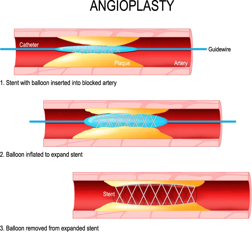 angioplasty
