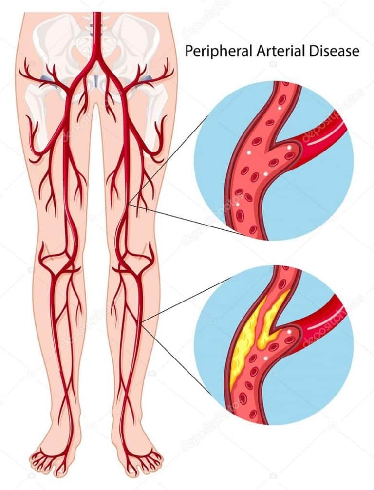 claudication-peripheral-arterial-disease-coastal-vascular-center