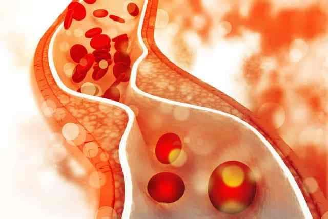 Blood Vessels in Artery - Causes of Peripheral Arterial Disease