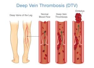 Deep Veins of the UE and LE (DVT) – Peripheral Brain