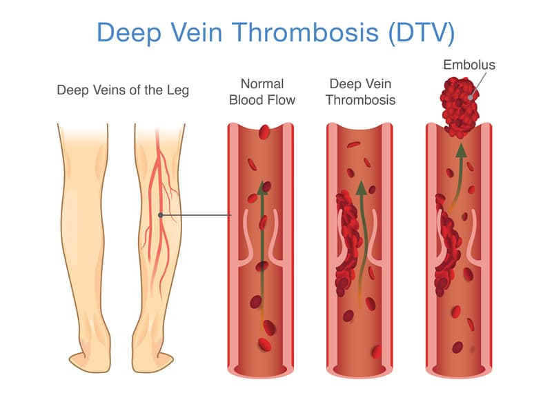 Deep Venous Thrombosis (DVT): Symptoms, Diagnosis, and Treatment: Vascular  Surgery Associates, LLC: Vascular Surgery