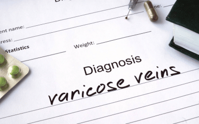 Are Varicose Veins the Sign of Something Bigger?