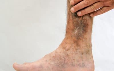 What To Know About Leg Ulcers