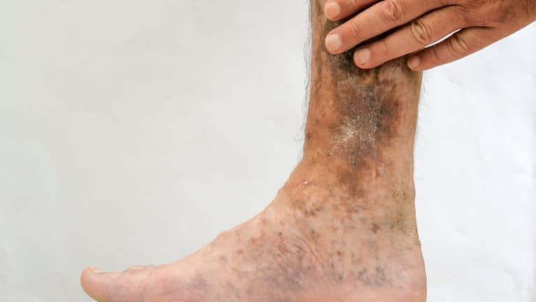 What To Know About Leg Ulcers – Coastal Vascular Center