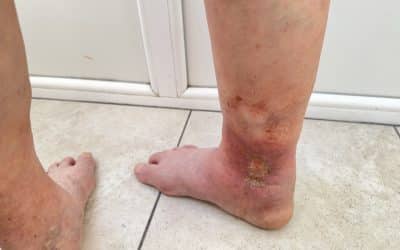 Unveiling the Mystery of Leg Ulcers