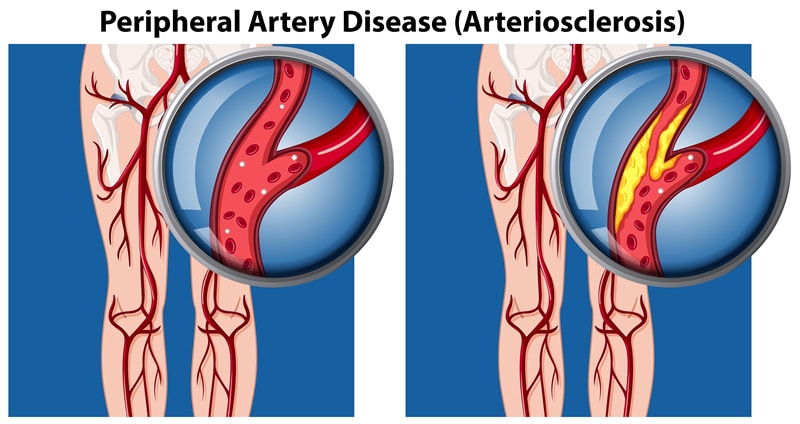 Peripherial Arterial Disease