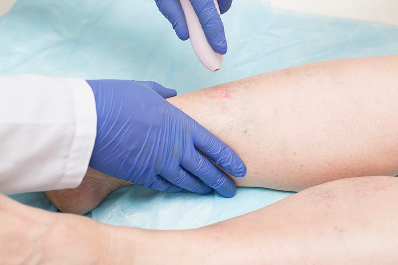 Laser Treatment For Varicose Veins