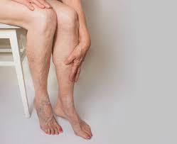 Cause of Leg Swelling