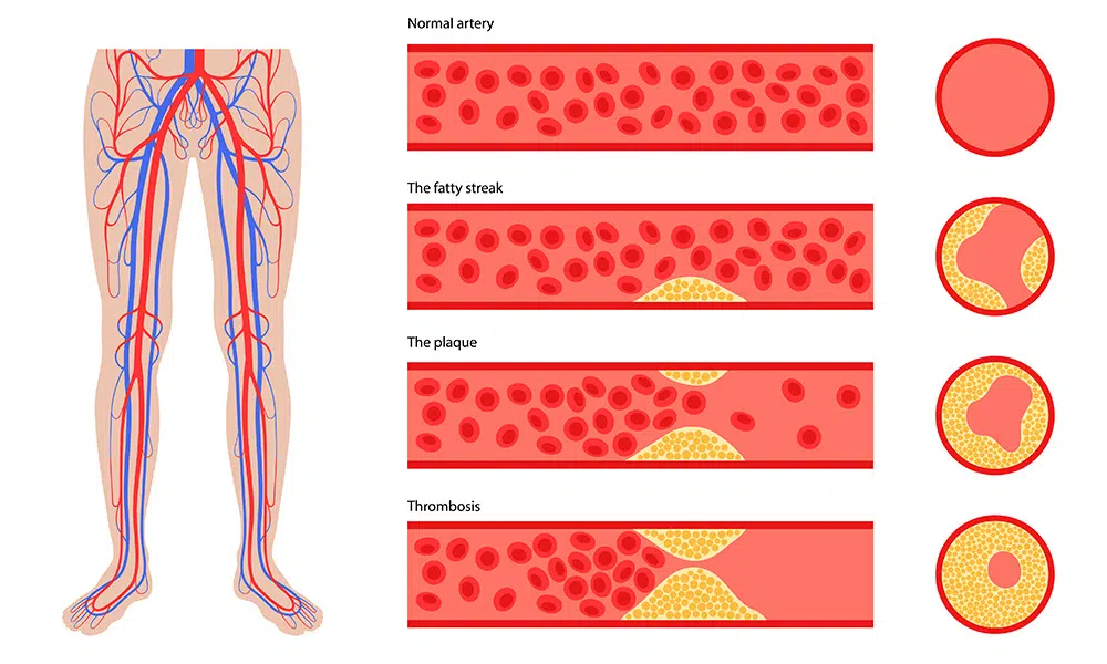 Peripheral Vascular Disease Diagram