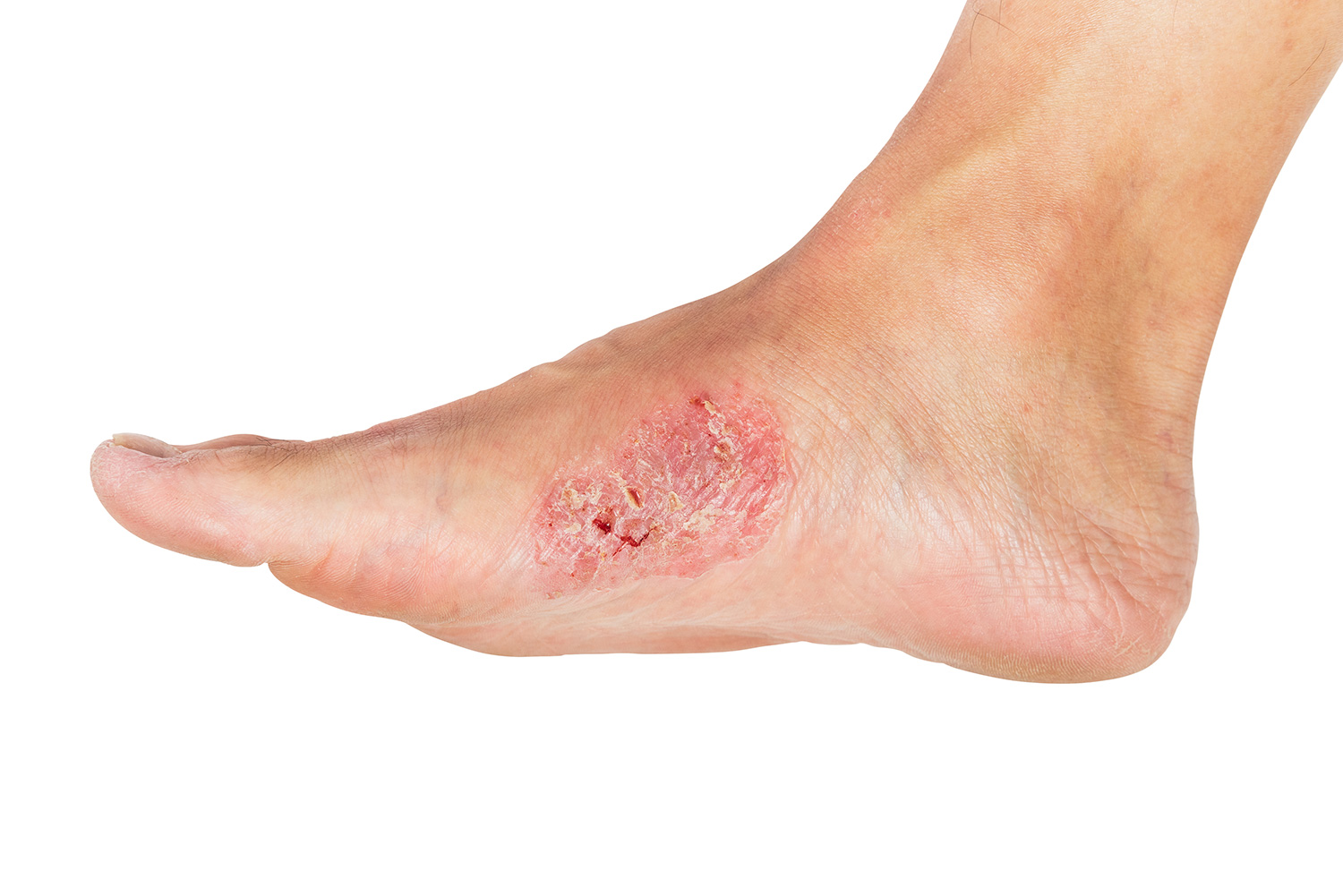 What Are Treatment Options For Venous Stasis Ulcers 