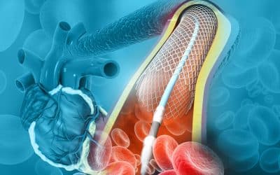 Angioplasty and Stent Placement Helps Open Up Block Arteries