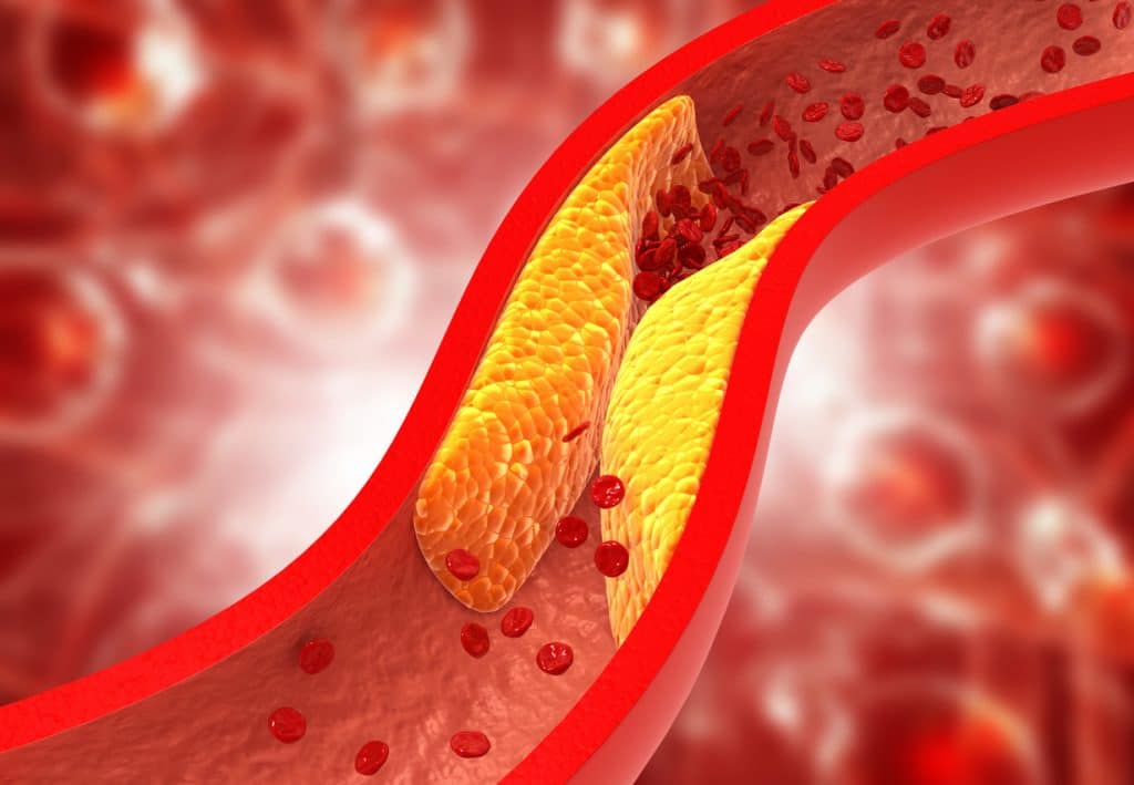 Arterial Disease - the closing of arteries
