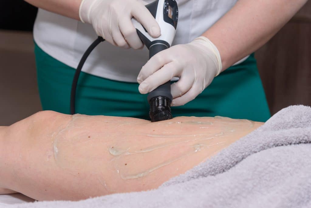 Radio-frequency Ablation on leg pigmentation