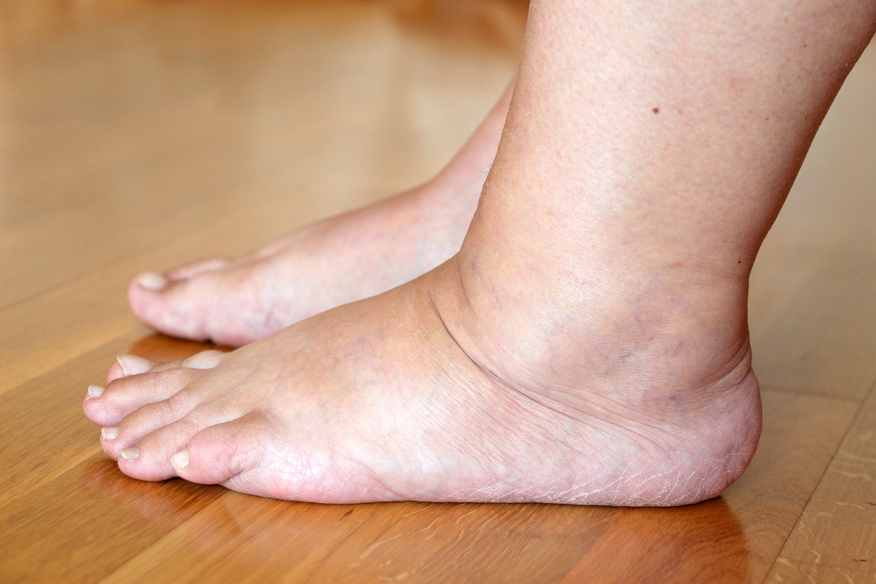 Understanding Leg Swelling Causes, Implications, & Treatment