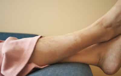 Understanding Changes Of Pigmentation On Your Legs
