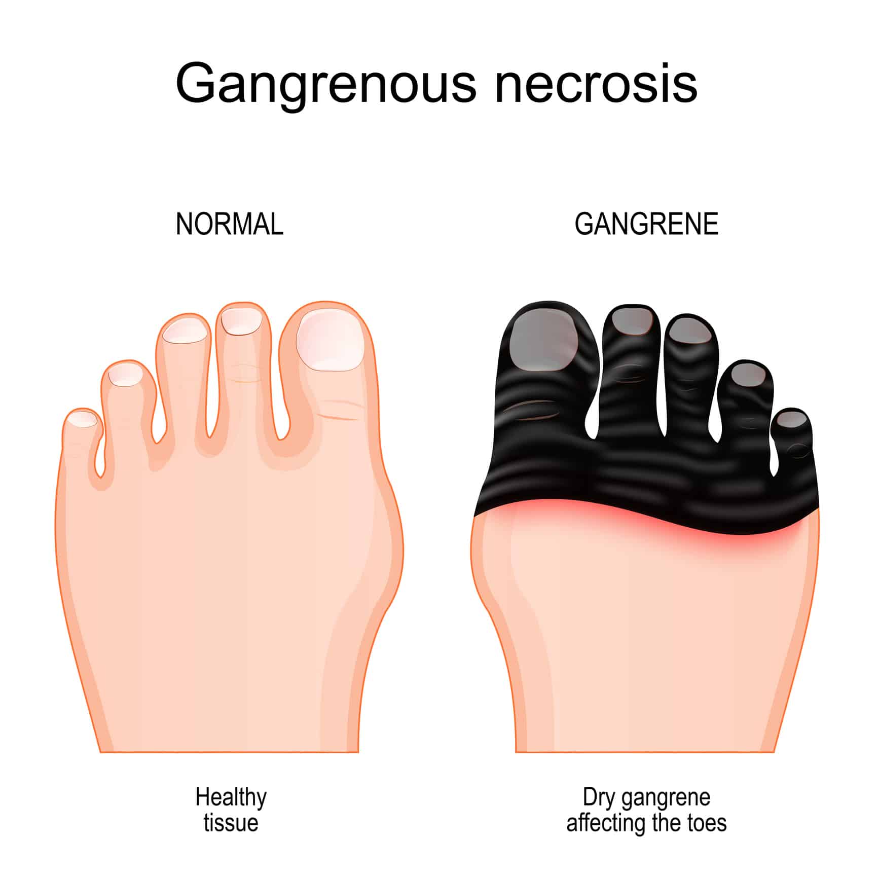 Gangrene Image