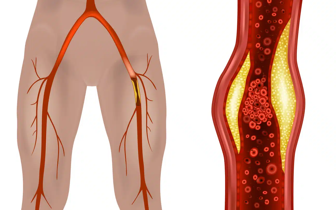Atherosclerosis of the extremities