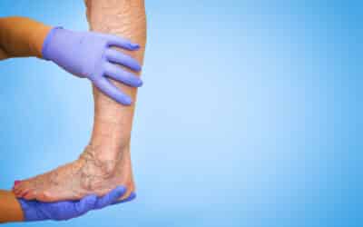 What Is Venous Insufficiency Disease