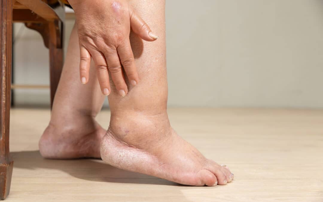 When to Seek Help for Leg Swelling