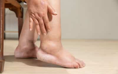 When to Seek Help for Leg Swelling